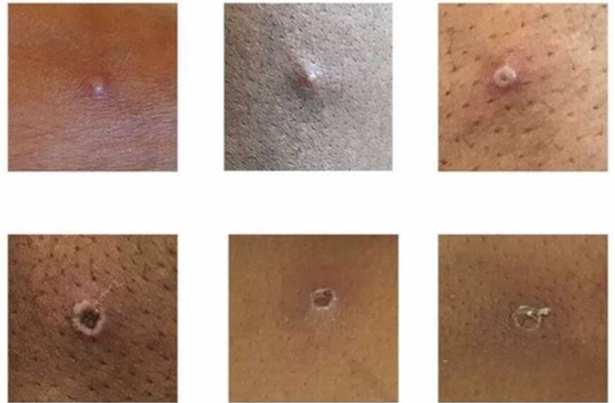 Castilla-La Mancha registra dos nuevos casos de viruela de mono en Toledo y Guadalajara