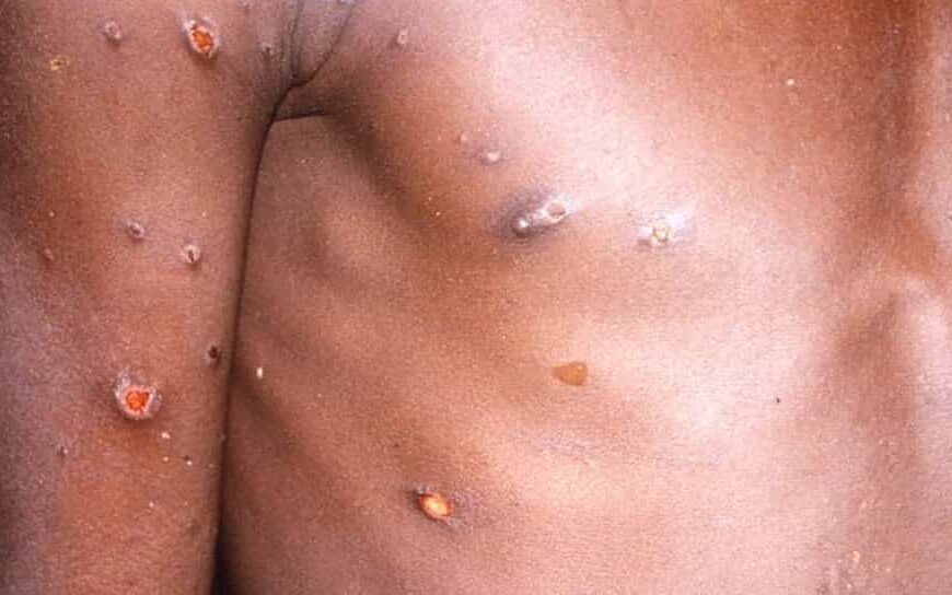 Castilla-La Mancha registra tres nuevos casos de viruela del mono y cuenta ya con 11 confirmados