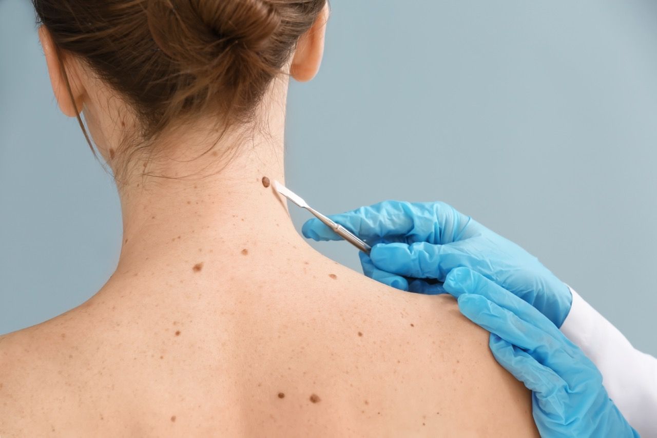 Bronceado Saludable: Mitos y Realidades para Pieles Sensibles según la Dra. Ángela Estenaga