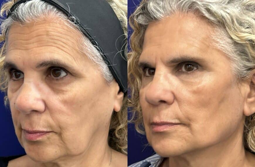 Global Face: La Revolución del Dr. Ángel Martín en Firmeza y Elasticidad Facial