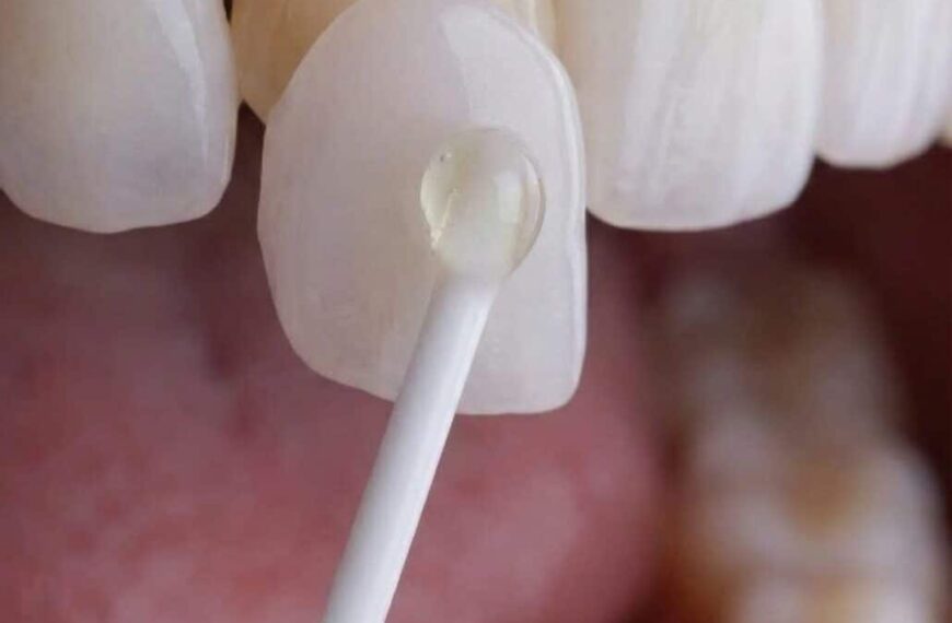 Descubre Finea®: Carillas Ultrafinas del Institut Volpe Lanza que Preservan Tu Sonrisa Natural